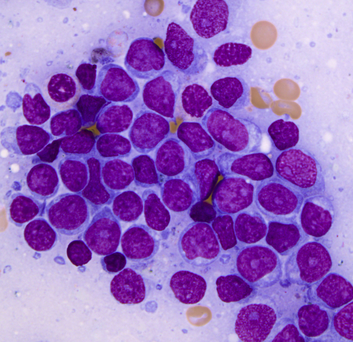 Bone marrow aspirate, Wright-Giemsa.